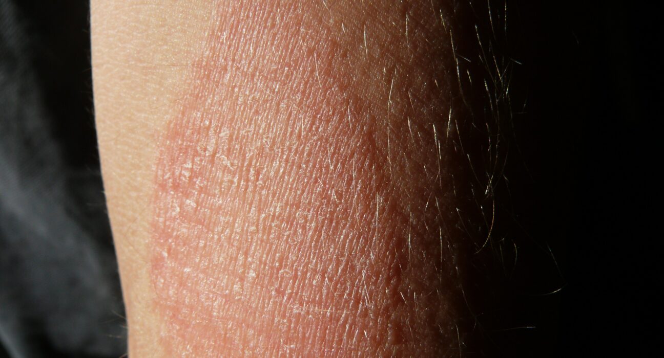 O que é dermatite no pé?