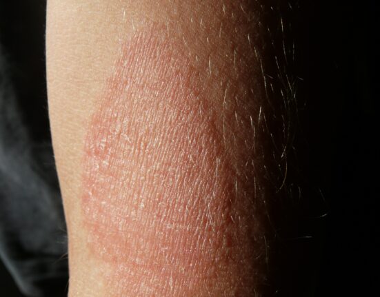 O que é dermatite no pé?